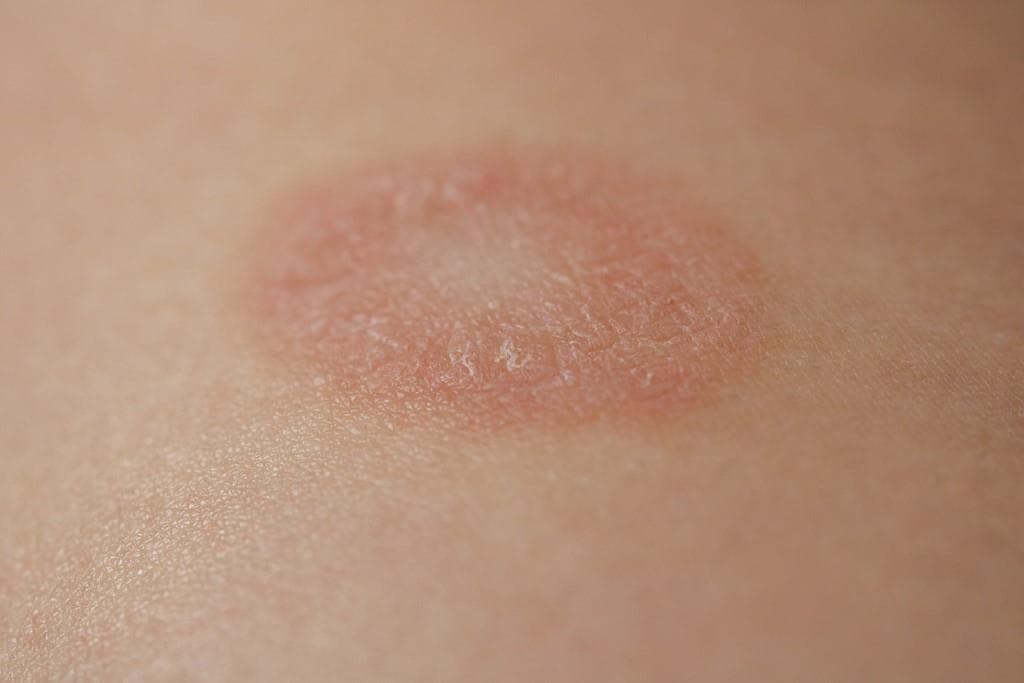 Conoce los síntomas del liquen escleroso vulvar