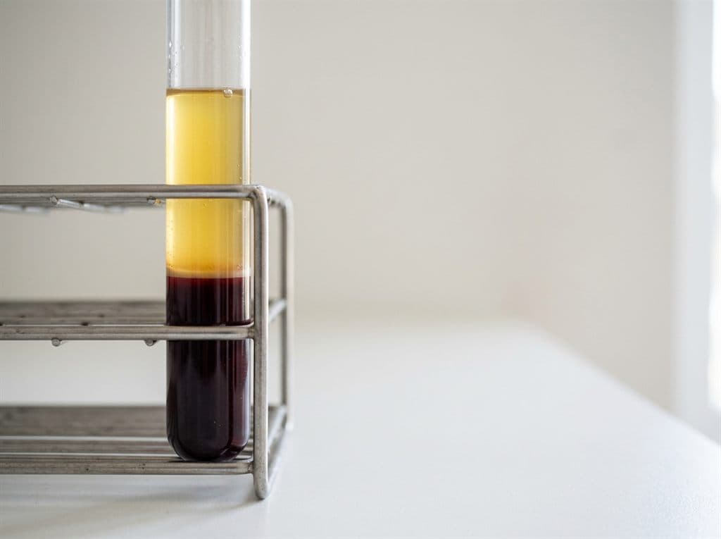Tratamiento con plasma rico en plaquetas en Vigo